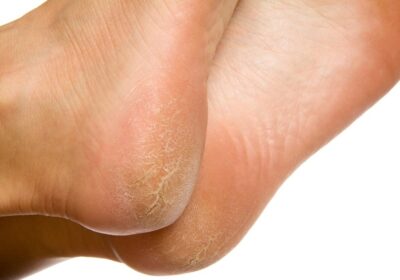 Cracked Heels: Factors, Symptoms and Treatment