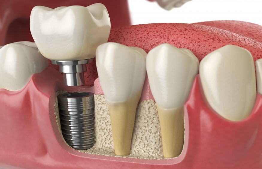 What Are Dental Implants