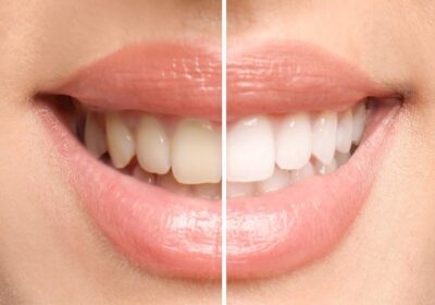 5 Signs You Need to Do Teeth Whitening in San Leandro, CA