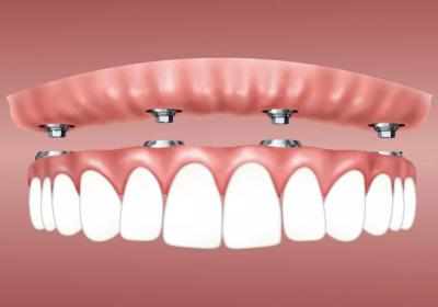 Dental Implants – What Are the Benefits?